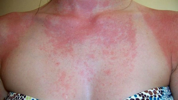 аллергия на солнце симптомы лечение фото