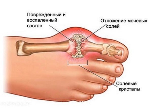 меню для больного подагрой на неделю. Смотреть фото меню для больного подагрой на неделю. Смотреть картинку меню для больного подагрой на неделю. Картинка про меню для больного подагрой на неделю. Фото меню для больного подагрой на неделю