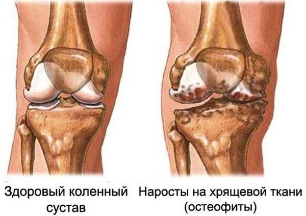 Артроз коленного сустава 