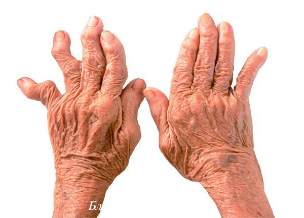 Артрит пальцев рук фото 