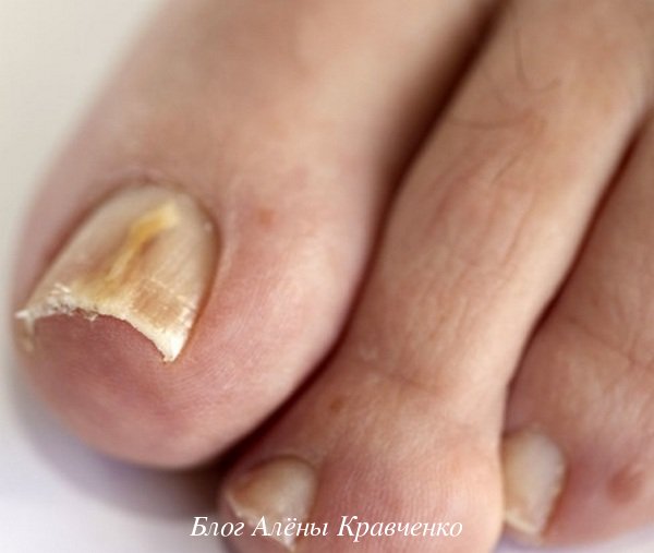 Дрожжевой грибок ногтя на большом пальце ноги 