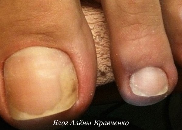 Грибок ногтя на большом пальце ноги 
