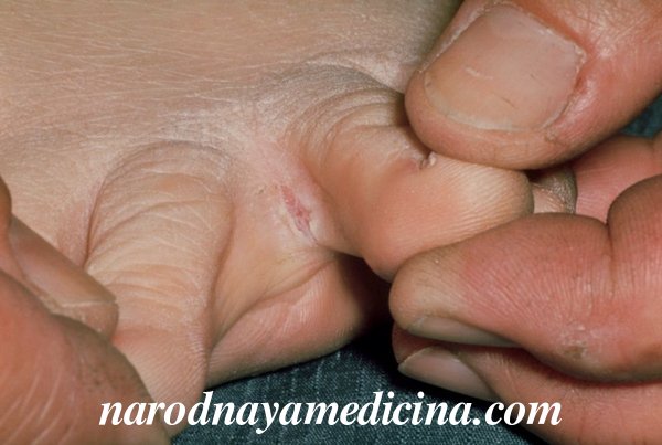 Трещины между пальцами на ногах 