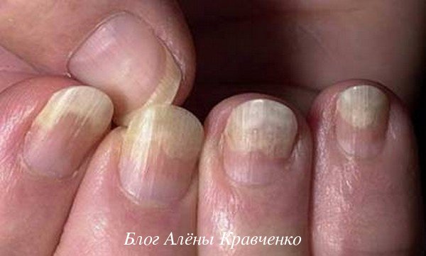 Основные причины грибка ногтей на руках