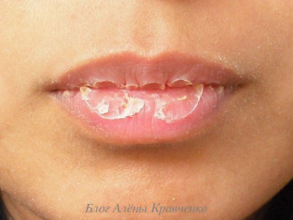 Сухость губ. Причины и лечение народными средствами