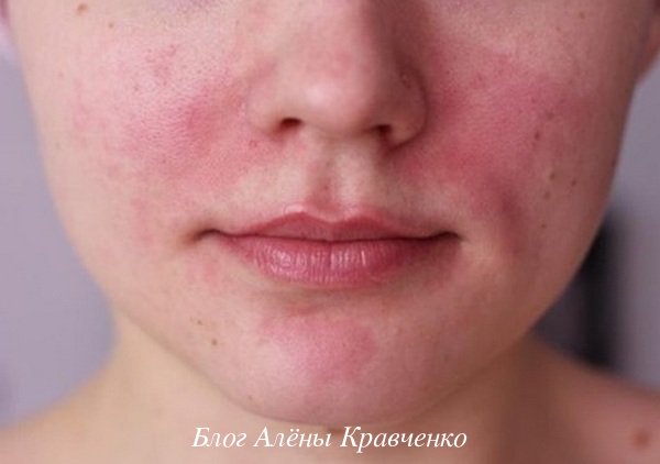 Аллергия на лице у взрослого: виды, симптомы, чем лечить, народные средства, диета